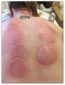 myofascial cupping daventry