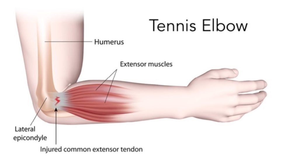 tennis-elbow-what-causes-it-symptoms-and-treatment-body